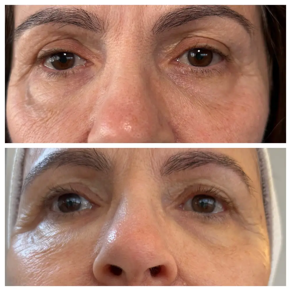 Antes e depois do tratamento para região dos olhos, caso 1