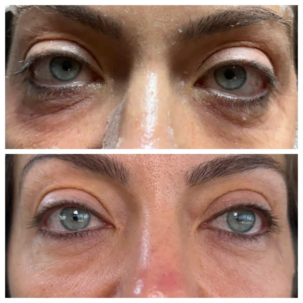 Antes e depois do tratamento para região dos olhos, caso 2